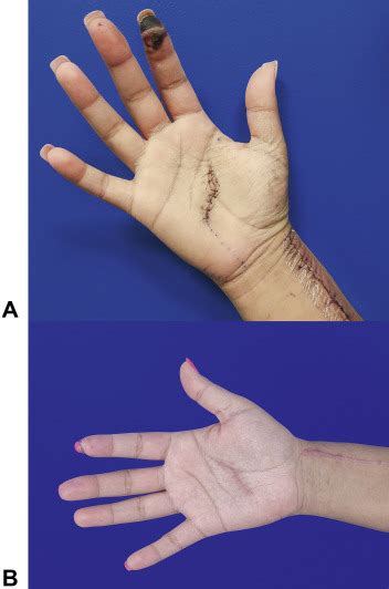 25 Avg LOS with ICD S60222A - Contusion of left hand, initial encounter 3. . Contusion left hand icd 10